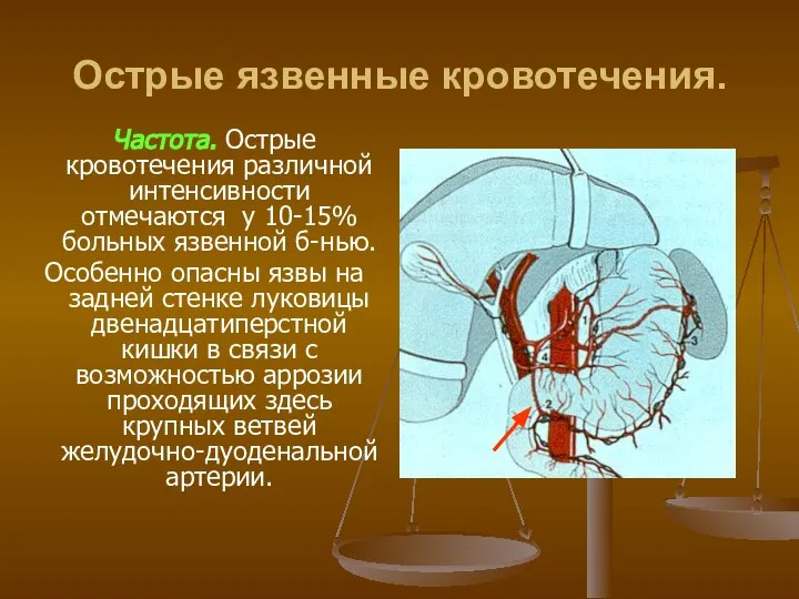 Острые язвенные кровотечения. Частота. Острые кровотечения различной интенсивности отмечаются у 10-15%