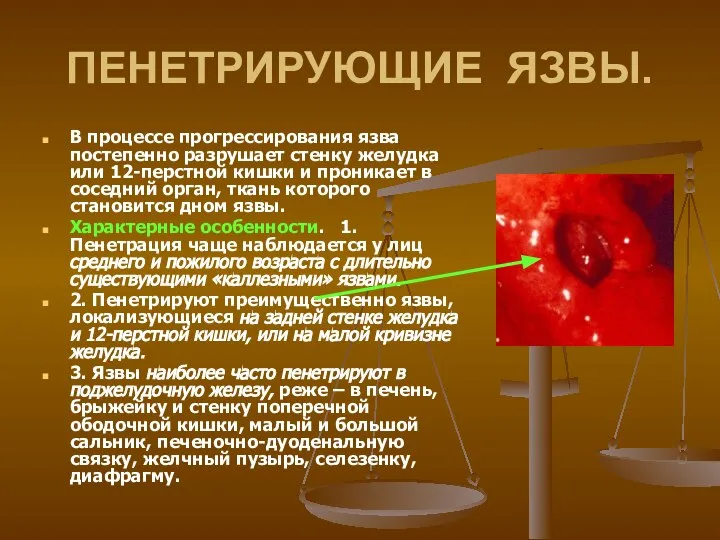 ПЕНЕТРИРУЮЩИЕ ЯЗВЫ. В процессе прогрессирования язва постепенно разрушает стенку желудка или