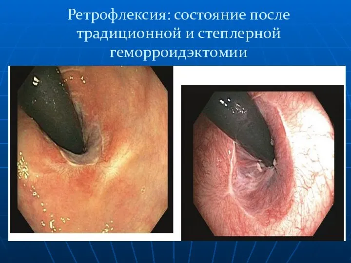 Ретрофлексия: состояние после традиционной и степлерной геморроидэктомии