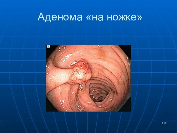 Аденома «на ножке»