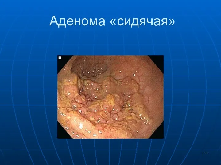 Аденома «сидячая»