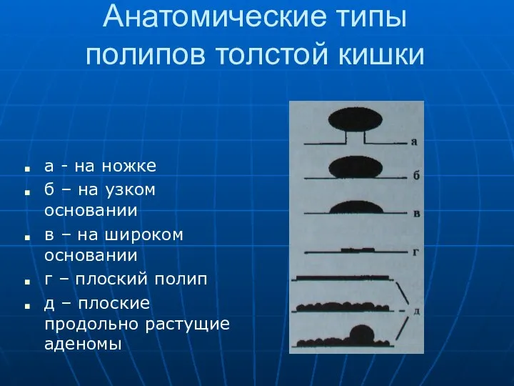 Анатомические типы полипов толстой кишки а - на ножке б –