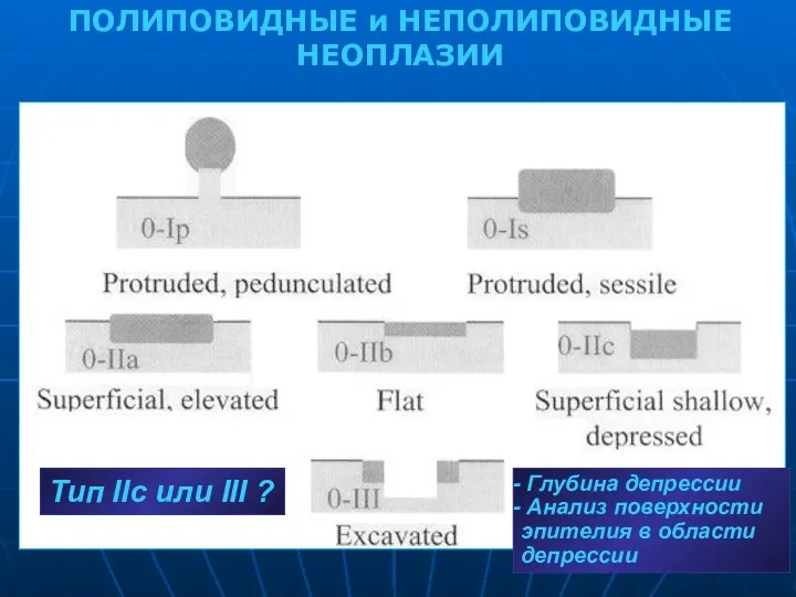 Глубина депрессии Анализ поверхности эпителия в области депрессии ПОЛИПОВИДНЫЕ и НЕПОЛИПОВИДНЫЕ