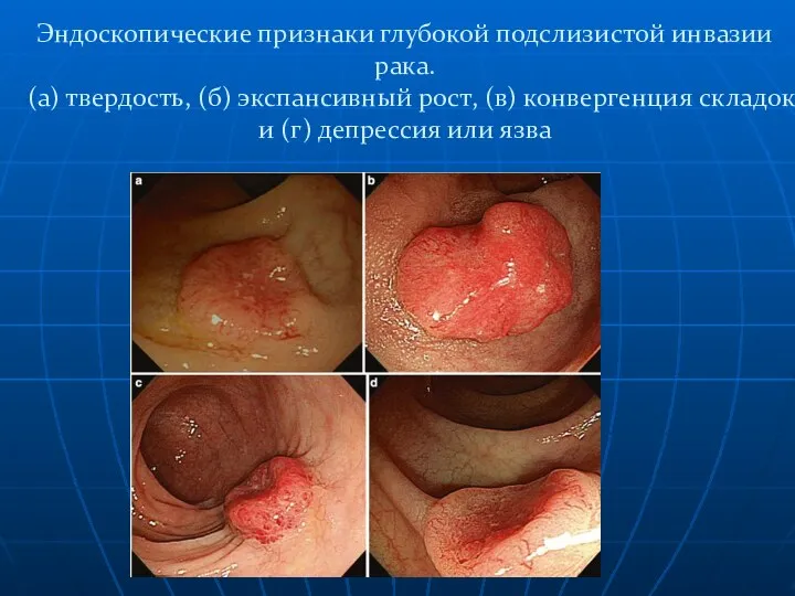 Эндоскопические признаки глубокой подслизистой инвазии рака. (а) твердость, (б) экспансивный рост,