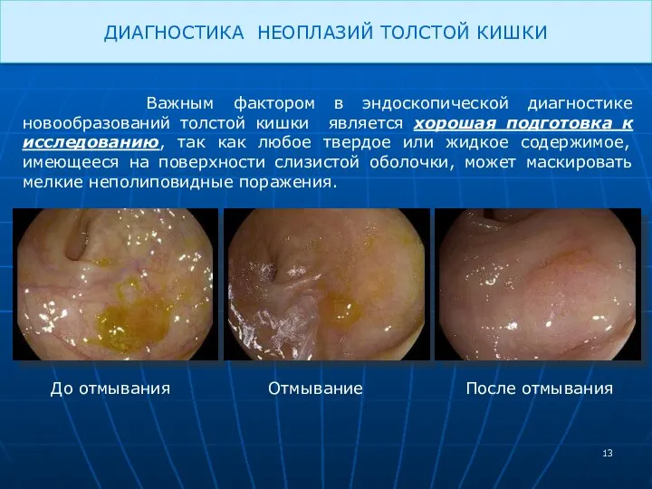 ДИАГНОСТИКА НЕОПЛАЗИЙ ТОЛСТОЙ КИШКИ Важным фактором в эндоскопической диагностике новообразований толстой