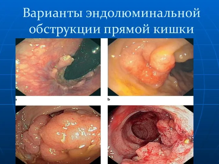 Варианты эндолюминальной обструкции прямой кишки