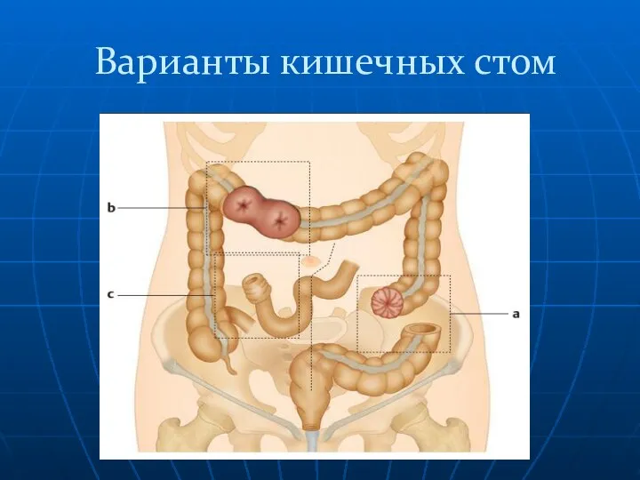 Варианты кишечных стом