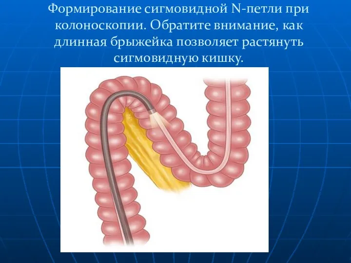 Формирование сигмовидной N-петли при колоноскопии. Обратите внимание, как длинная брыжейка позволяет растянуть сигмовидную кишку.