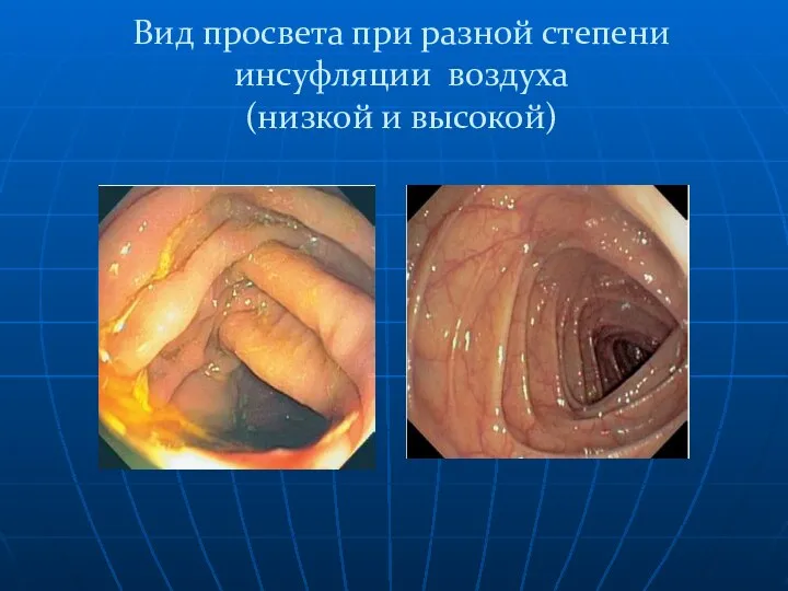 Вид просвета при разной степени инсуфляции воздуха (низкой и высокой)