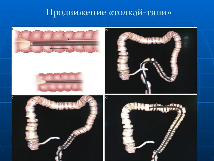 Продвижение «толкай-тяни»