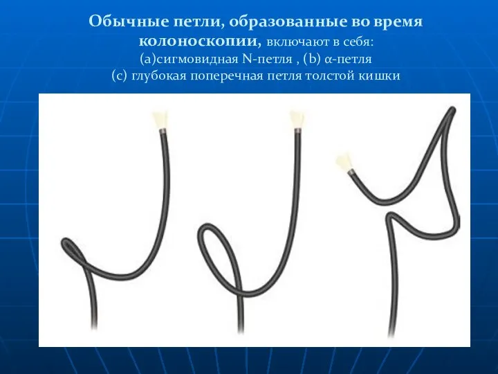 Обычные петли, образованные во время колоноскопии, включают в себя: (а)сигмовидная N-петля