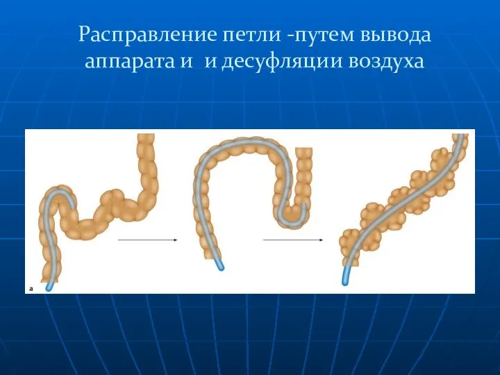 Расправление петли -путем вывода аппарата и и десуфляции воздуха