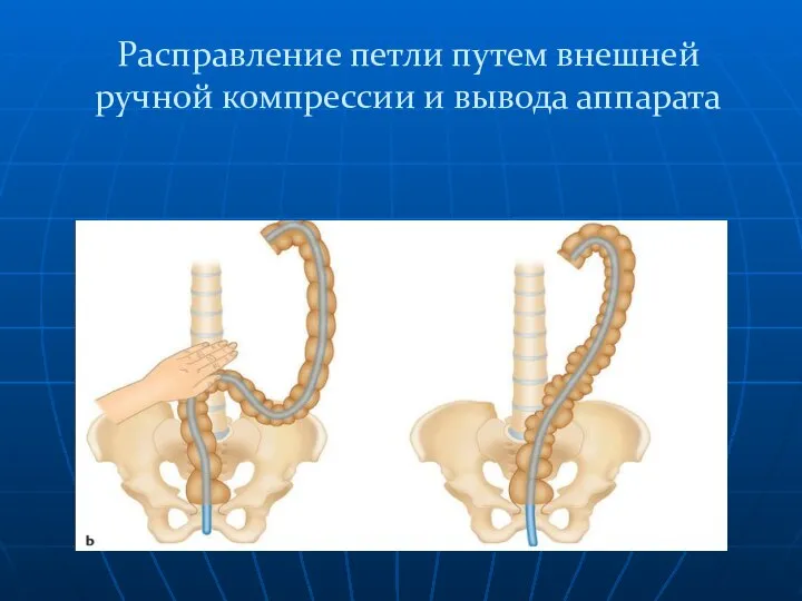 Расправление петли путем внешней ручной компрессии и вывода аппарата