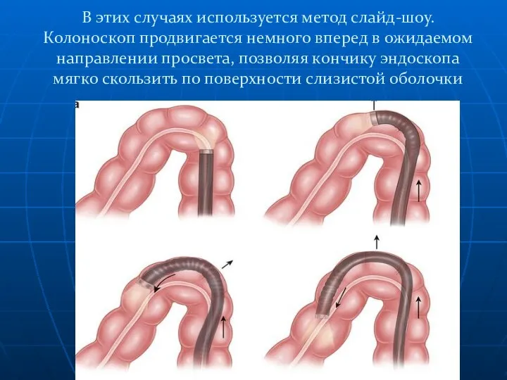 В этих случаях используется метод слайд-шоу. Колоноскоп продвигается немного вперед в