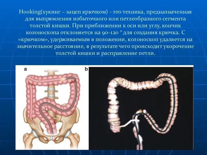 Hooking(хукинг – зацеп крючком) - это техника, предназначенная для выпрямления избыточного