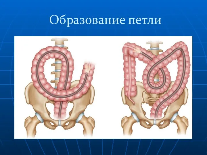 Образование петли