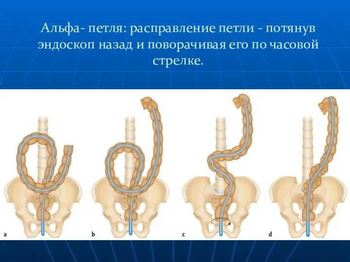 Альфа- петля: расправление петли - потянув эндоскоп назад и поворачивая его по часовой стрелке.