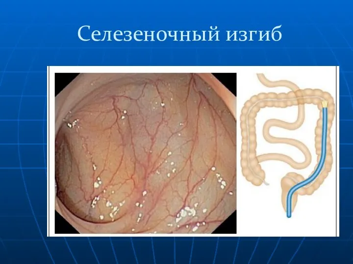 Селезеночный изгиб