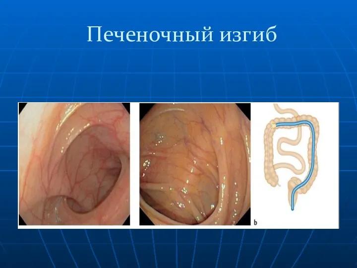 Печеночный изгиб