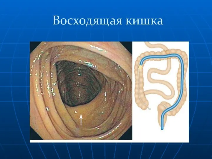 Восходящая кишка