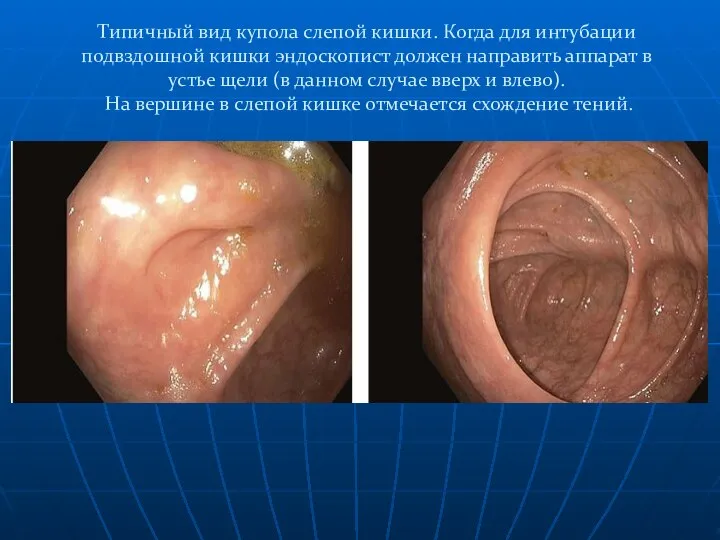 Типичный вид купола слепой кишки. Когда для интубации подвздошной кишки эндоскопист