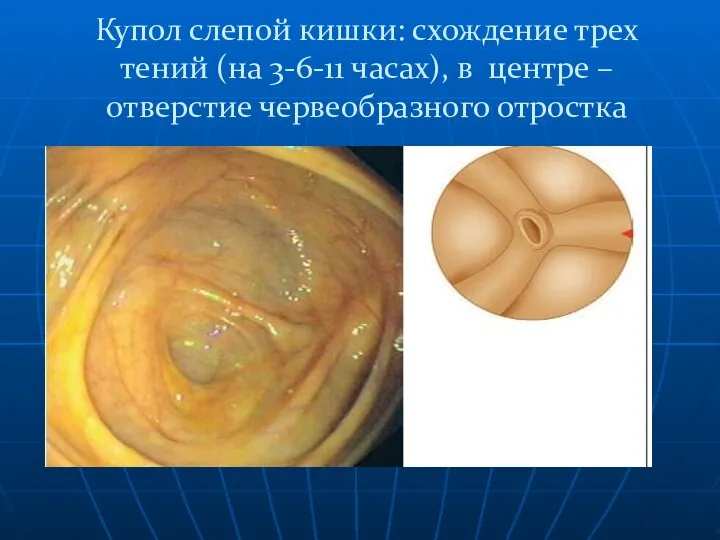 Купол слепой кишки: схождение трех тений (на 3-6-11 часах), в центре – отверстие червеобразного отростка