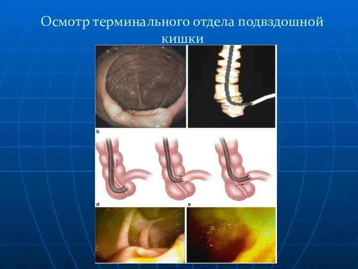 Осмотр терминального отдела подвздошной кишки