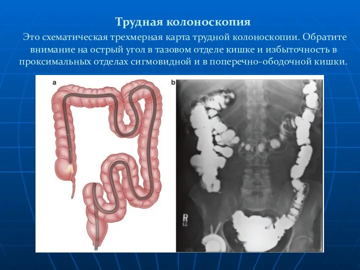 Трудная колоноскопия Это схематическая трехмерная карта трудной колоноскопии. Обратите внимание на