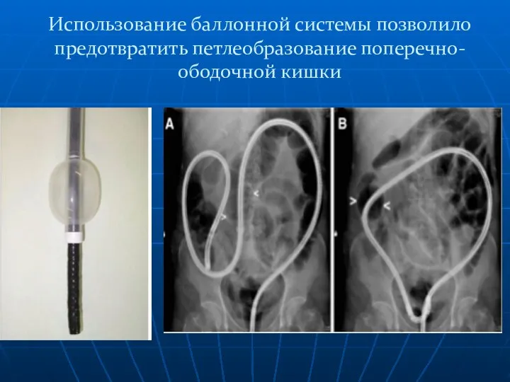 Использование баллонной системы позволило предотвратить петлеобразование поперечно-ободочной кишки