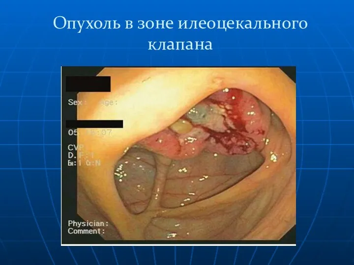 Опухоль в зоне илеоцекального клапана