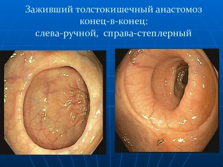 Заживший толстокишечный анастомоз конец-в-конец: слева-ручной, справа-степлерный