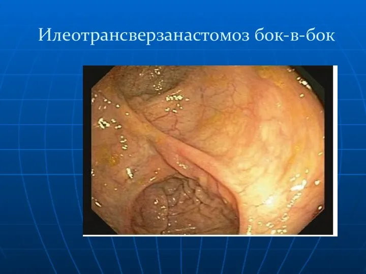 Илеотрансверзанастомоз бок-в-бок