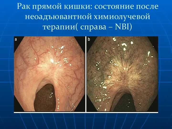 Рак прямой кишки: состояние после неоадъювантной химиолучевой терапии( справа – NBI)