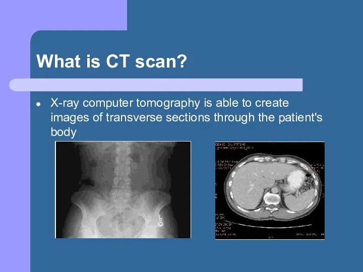 What is CT scan? X-ray computer tomography is able to create