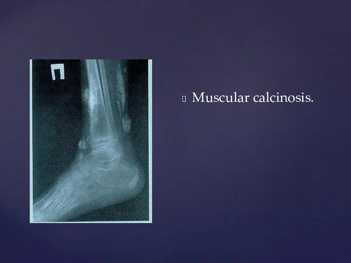 Muscular calcinosis.