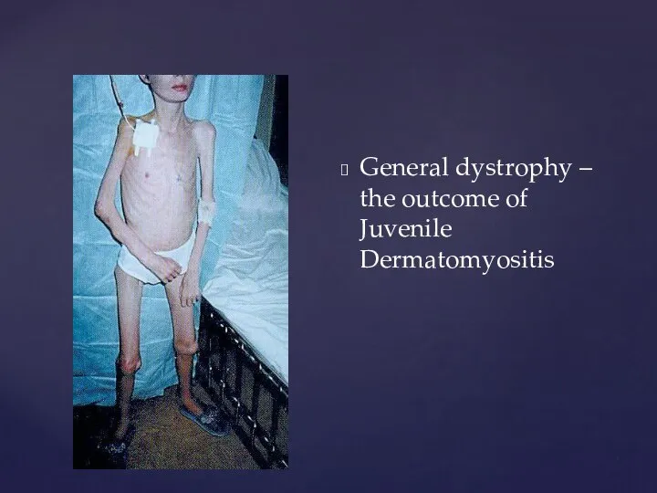 General dystrophy – the outcome of Juvenile Dermatomyositis