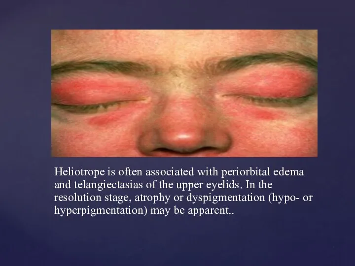 Heliotrope is often associated with periorbital edema and telangiectasias of the