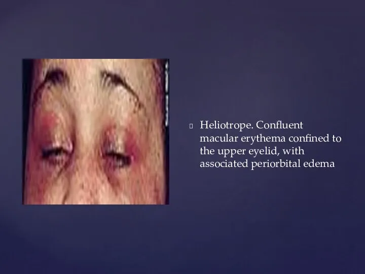 Heliotrope. Confluent macular erythema confined to the upper eyelid, with associated periorbital edema