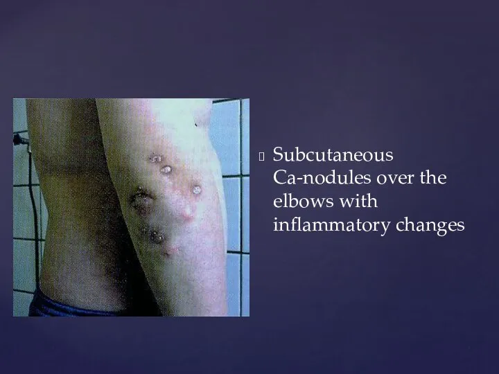 Subcutaneous Ca-nodules over the elbows with inflammatory changes