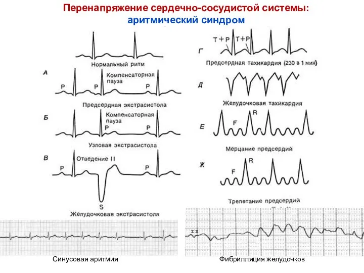 Фибрилляция желудочков Перенапряжение сердечно-сосудистой системы: аритмический синдром Синусовая аритмия