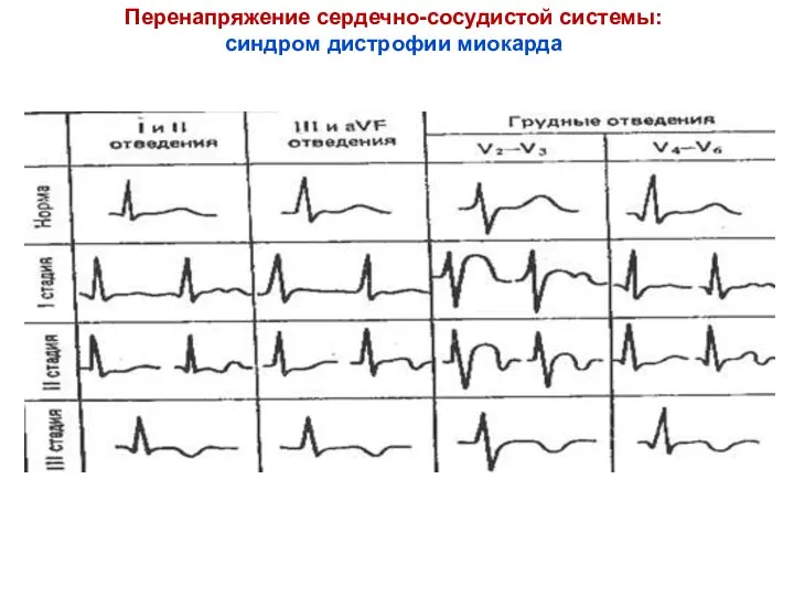 Перенапряжение сердечно-сосудистой системы: синдром дистрофии миокарда