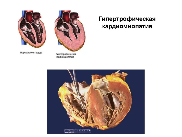 Гипертрофическая кардиомиопатия