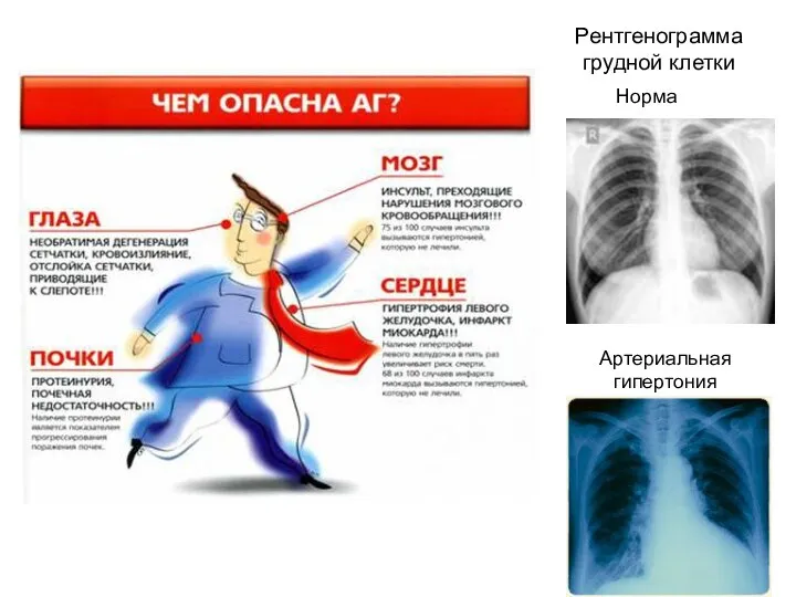 Рентгенограмма грудной клетки Норма Артериальная гипертония