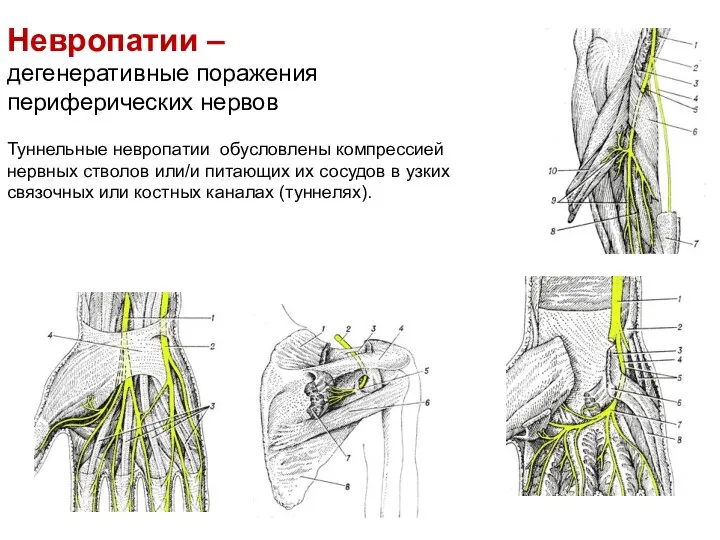 Невропатии – дегенеративные поражения периферических нервов Туннельные невропатии обусловлены компрессией нервных