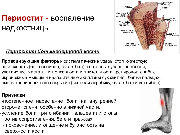 Признаки: -постепенное нарастание боли на внутренней стороне голени, особенно в нижней