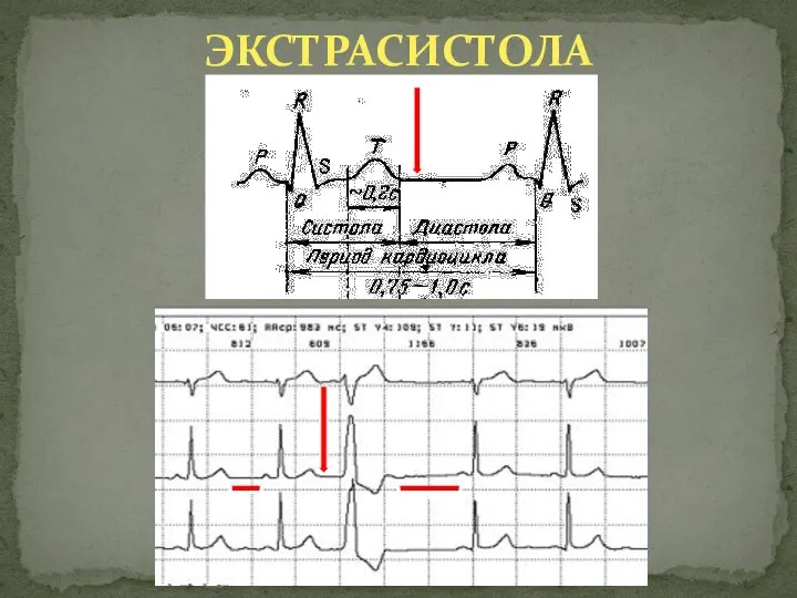 ЭКСТРАСИСТОЛА