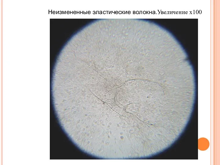 Неизмененные эластические волокна.Увеличение х100