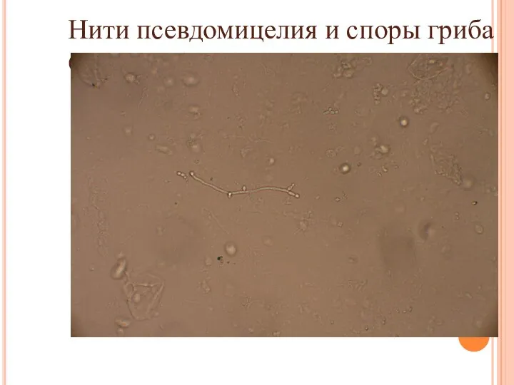 Нити псевдомицелия и споры гриба Candida albicans. Увеличение х 400.