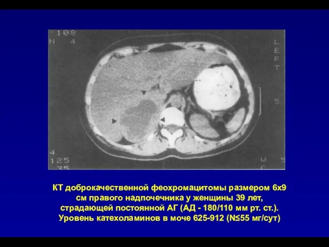 КТ доброкачественной феохромацитомы размером 6х9 см правого надпочечника у женщины 39