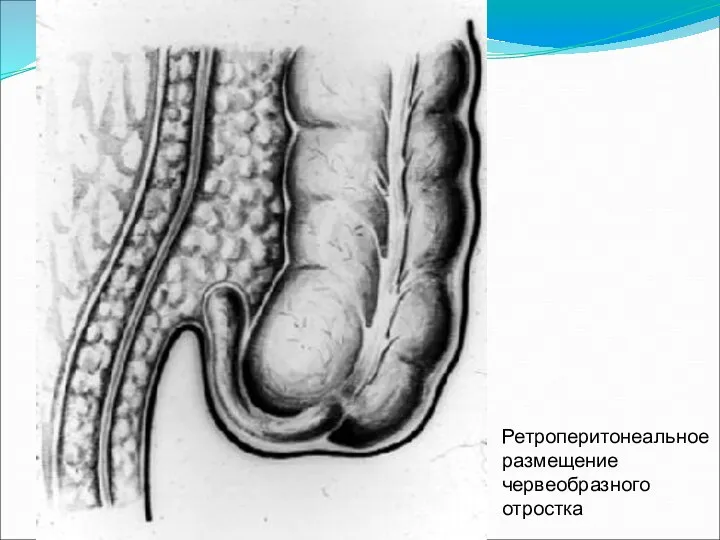 Ретроперитонеальное размещение червеобразного отростка